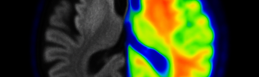 A composite image of a brain, with the left hemisphere in detailed gray tones and the right hemisphere depicted with a vibrant red, orange, and green functional map.