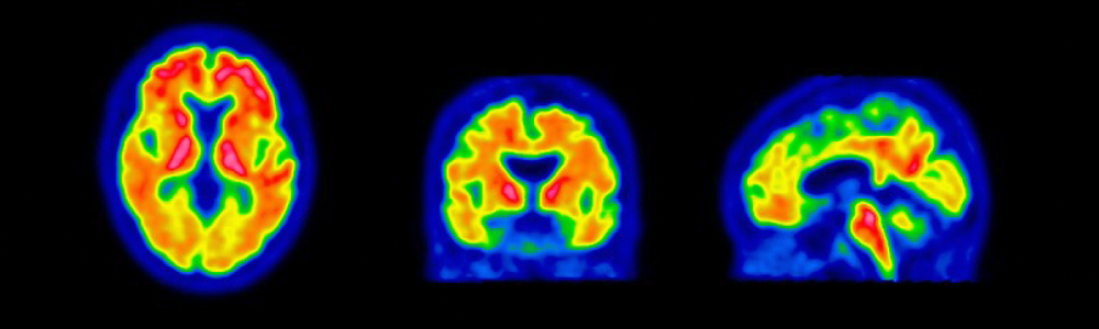 A colorful brain imaging scan displaying different cross-sections (top, front, side) with varying levels of activity indicated by a spectrum from blue to red.