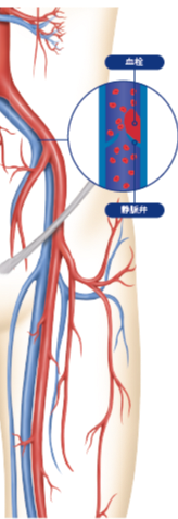 深部静脈血栓症（DVT）の発生イメージ