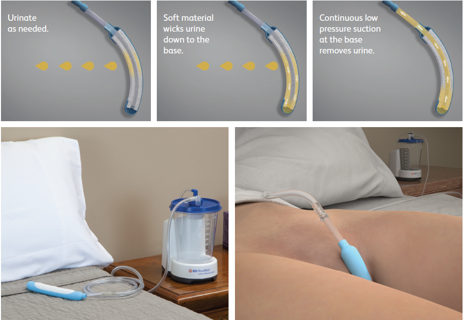 BD PureWick™ Urine Collection System